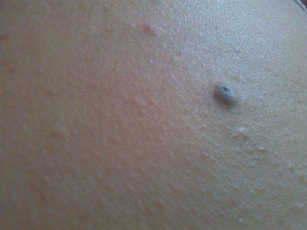 宝宝胸前长了颗小肉粒变黑了,后背老是抠出米粒一样的东西