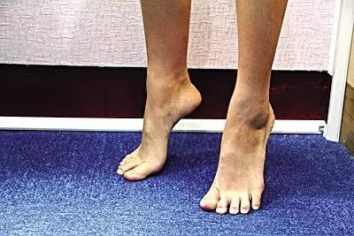 足底筋膜炎还可以跑步吗,跑步足底筋膜炎康复训练