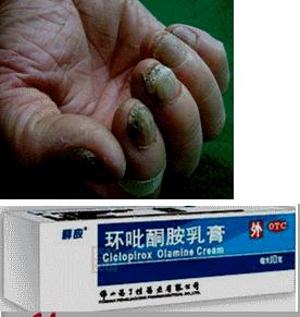 脚气真菌感染灰指甲用什么药膏,真菌感染怎么彻底根除脚气灰指甲