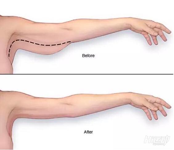 甩掉手臂拜拜肉最快的方法,超简单的五分钟瘦手臂动作