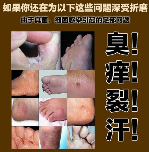香港脚止痒克星,香港脚痒怎么治才能除根