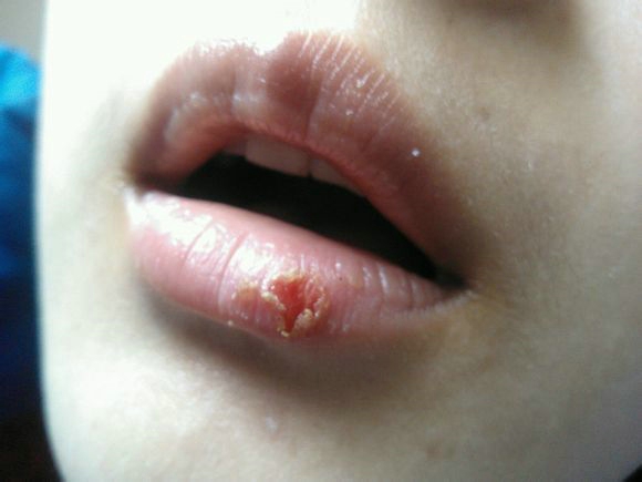 嘴上长泡长疱疹瘙痒怎么办注意这几点。。。