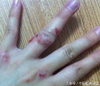 湿疹中医辨证,湿疹性皮炎中医辨证