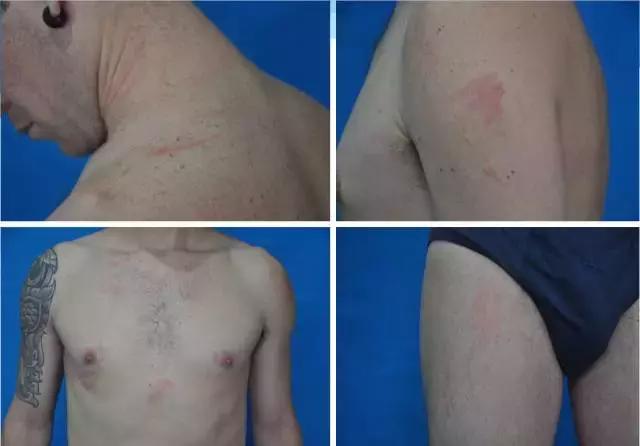 巴西男子身上莫名出现多处“鞭”痕,只因做了这件事...