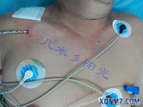 锁骨下静脉穿刺为什么会出现血胸,锁骨下静脉穿刺回血不畅怎么办