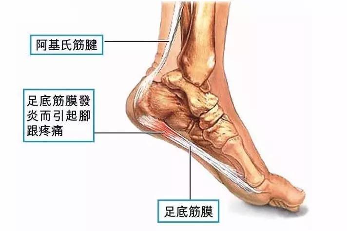 足底筋膜炎还可以跑步吗,跑步足底筋膜炎康复训练