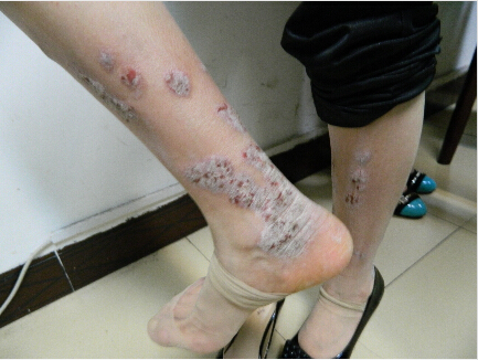 麻疹和荨麻疹的区别是什么,荨麻疹与湿疹的症状有什么区别