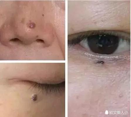 黑斑可能是皮肤癌，不要不当回事！