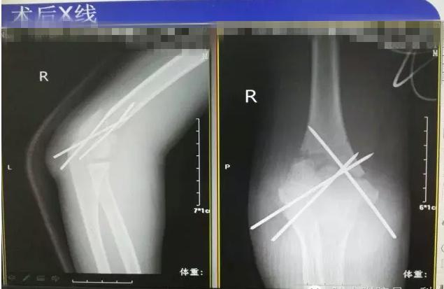 肱骨髁上骨折闭合复位手术记录,小儿肱骨髁上骨折手术恢复的概率