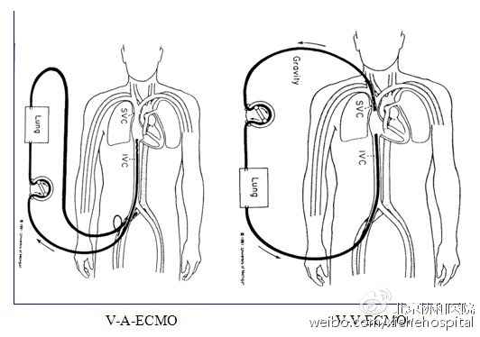 ecmow为啥特别贵,人工肺ecmo为什么这么贵