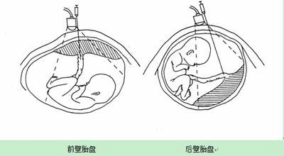 试管婴儿唐氏筛查高危,唐氏筛查高危胎儿症状