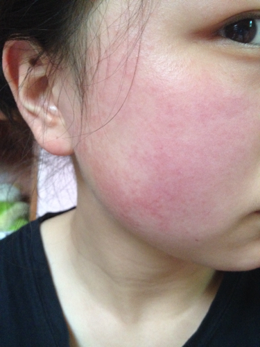 吃海鲜过敏症状表现图片,为什么有人吃海鲜螃蟹过敏