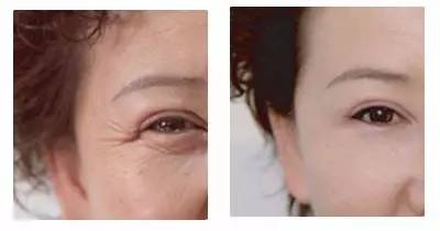 怎么去除黑眼圈又简单又有效,有什么去除黑眼圈的好办法