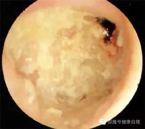 化脓性中耳炎饮食禁忌,化脓性中耳炎中医治疗
