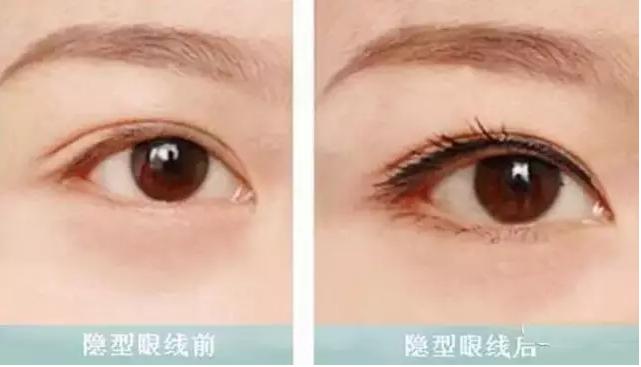 做美瞳线的技巧和方法,教你如何选择美瞳线