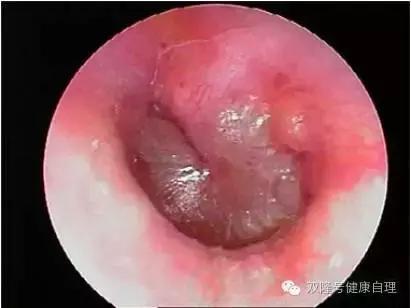 化脓性中耳炎饮食禁忌,化脓性中耳炎中医治疗