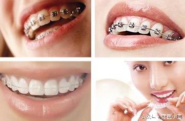 隐形牙套一般价格,戴一个隐形牙套多少钱