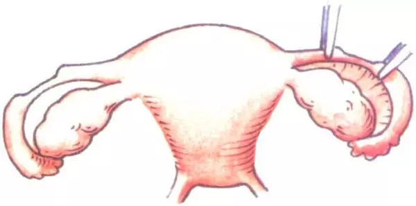 女性二胎后做结扎有影响吗,二胎结扎后想生三胎