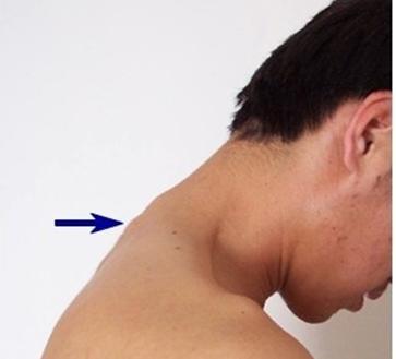 颈椎疼痛的自我治疗方法,颈椎自我复位方法