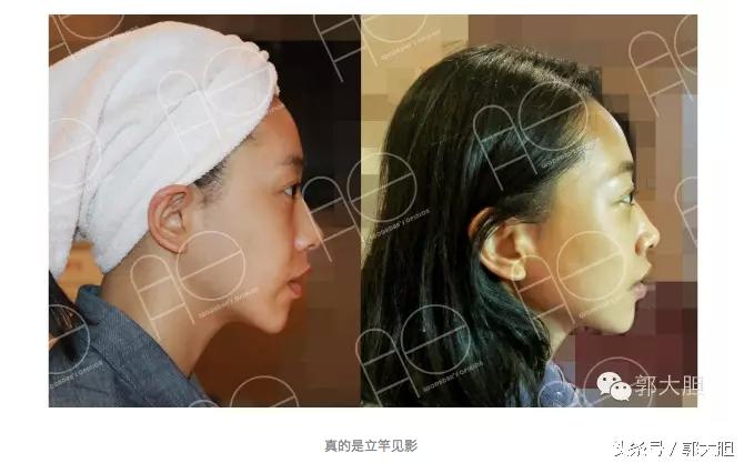 当你以为抗老还要靠超声刀的时候,我去打了更牛X的热拉提