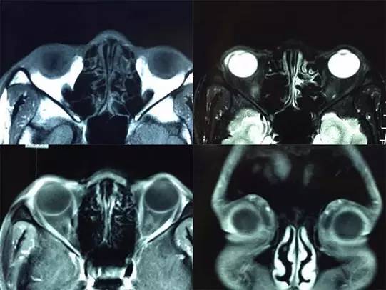 眼球白色边缘有一个囊肿怎么治疗,眼球结膜囊肿如何自己排脓