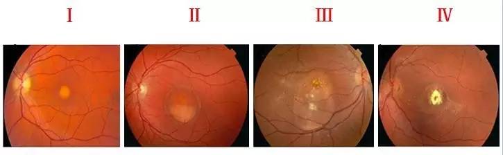 CCOS2016眼底陈有信教授：Best病及基因型与表现型研究