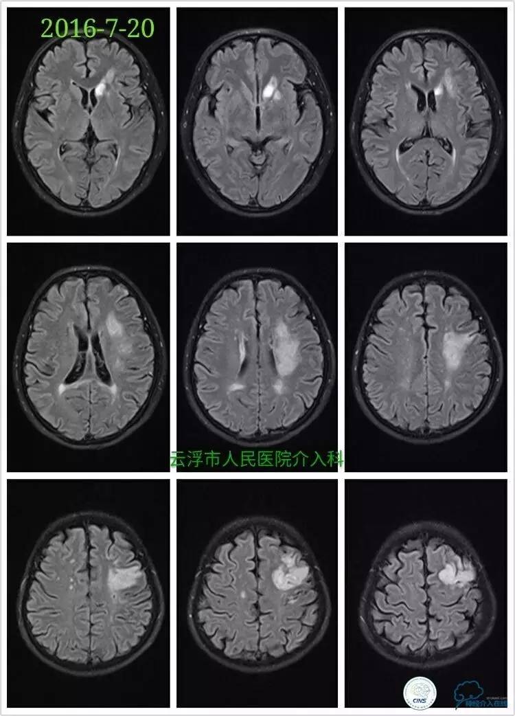 脑血管介入培训基地,脑卒中血管介入治疗