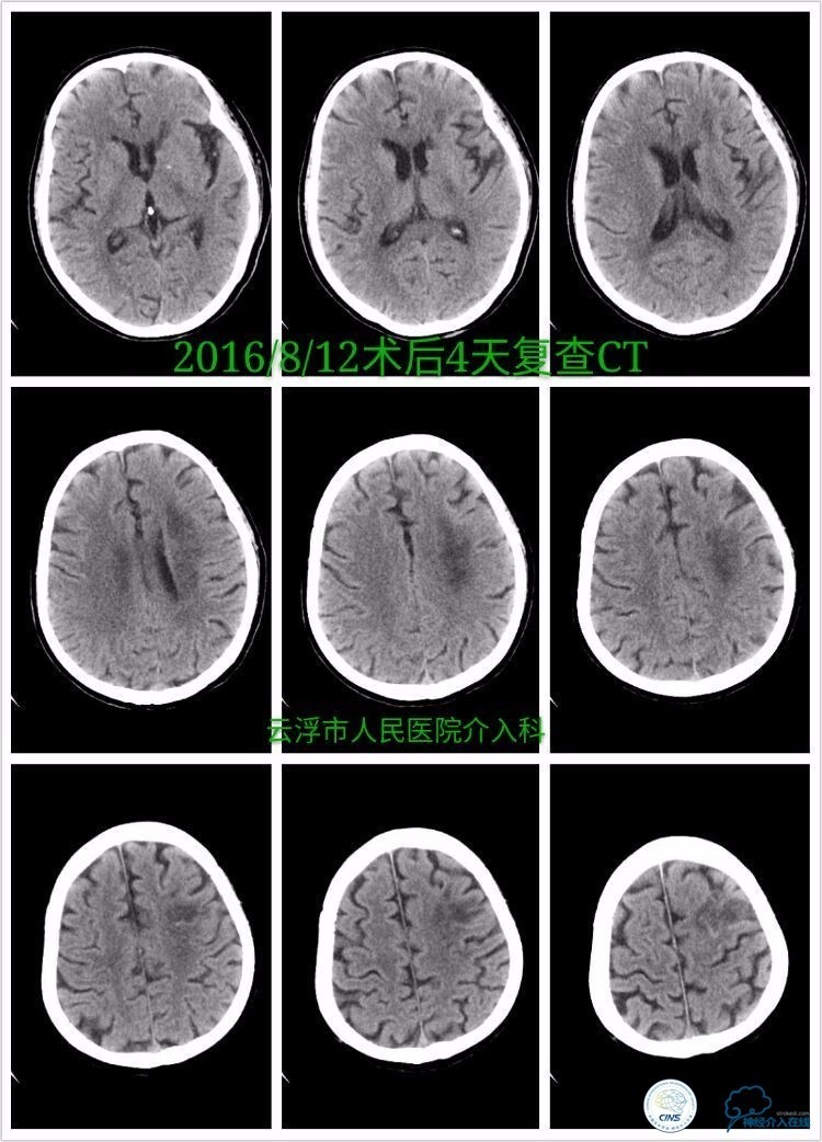 脑血管介入培训基地,脑卒中血管介入治疗