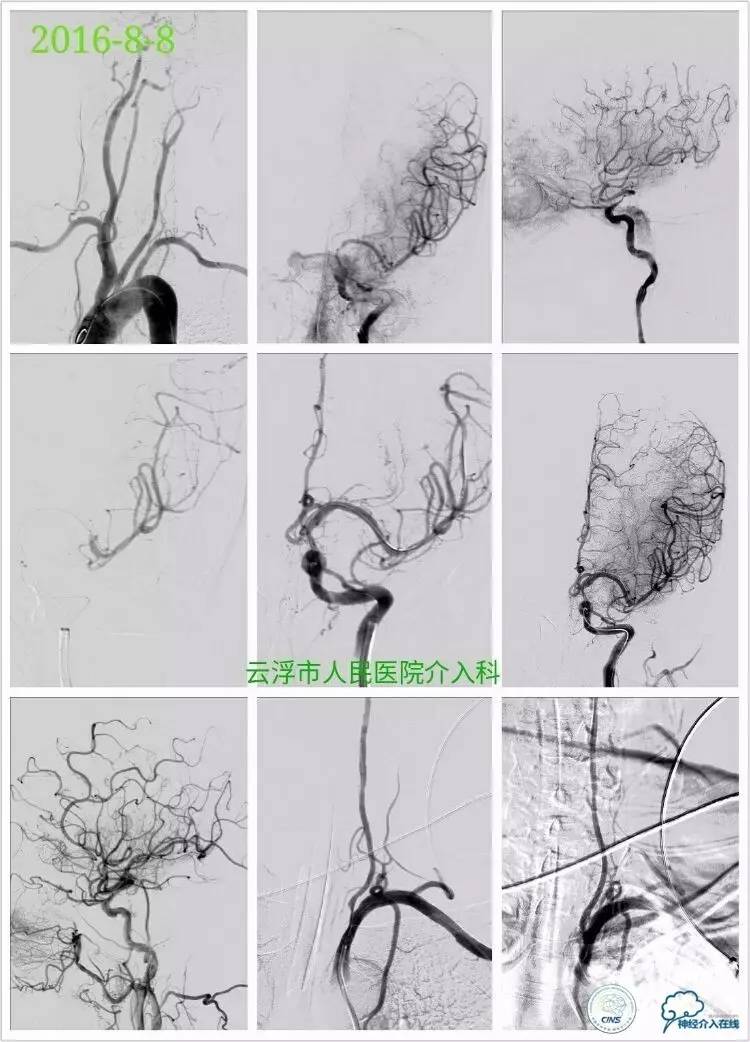 脑血管介入培训基地,脑卒中血管介入治疗