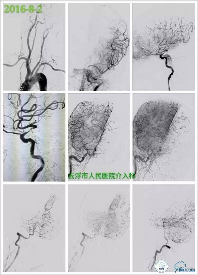 脑血管介入培训基地,脑卒中血管介入治疗