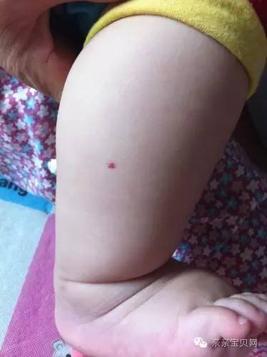 红痣与黑痣对人体健康的影响,红痣竟是健康信号灯