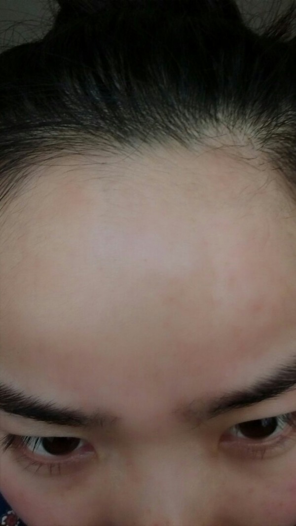 拯救爆痘肌肤,刷酸爆痘脱皮需要怎么办呢