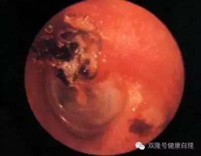化脓性中耳炎饮食禁忌,化脓性中耳炎中医治疗