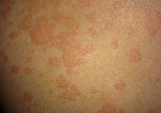 吃海鲜过敏症状表现图片,为什么有人吃海鲜螃蟹过敏