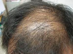 头发上出油用中药怎么治,头发爱出油脱发吃什么中成药调理