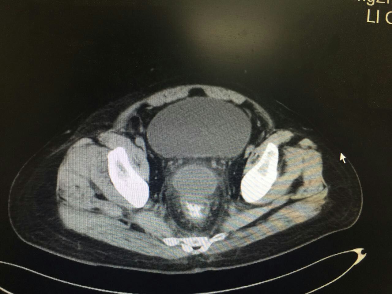 阑尾手术完5天大便稀,阑尾切除后大便很久