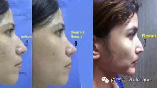 整容失败有多可怕,整容失败多可怕