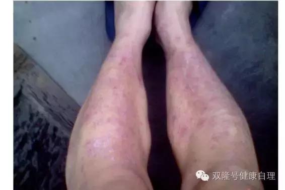 中医说吃醪糟的好处,中医说伤阴最严重症状