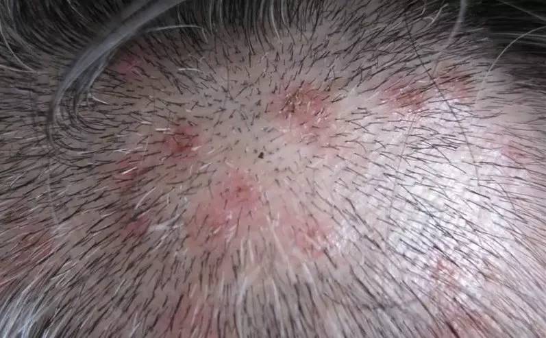 得了脂溢性皮炎会不会秃,得了脂溢性皮炎一定会秃顶吗