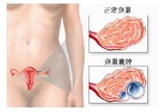 绝经后长卵巢囊肿是什么原因引起,卵巢囊肿是什么原因引起的呢