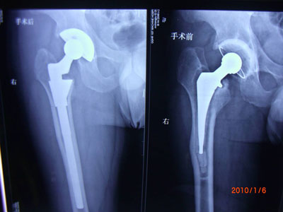 骨刺或者骨质增生能动手术去除吗,骨刺和骨质增生都做什么样的手术