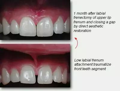 牙中间有缝怎么办,前牙有缝修复