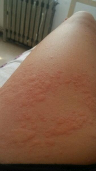 麻疹和荨麻疹的区别是什么,荨麻疹与湿疹的症状有什么区别