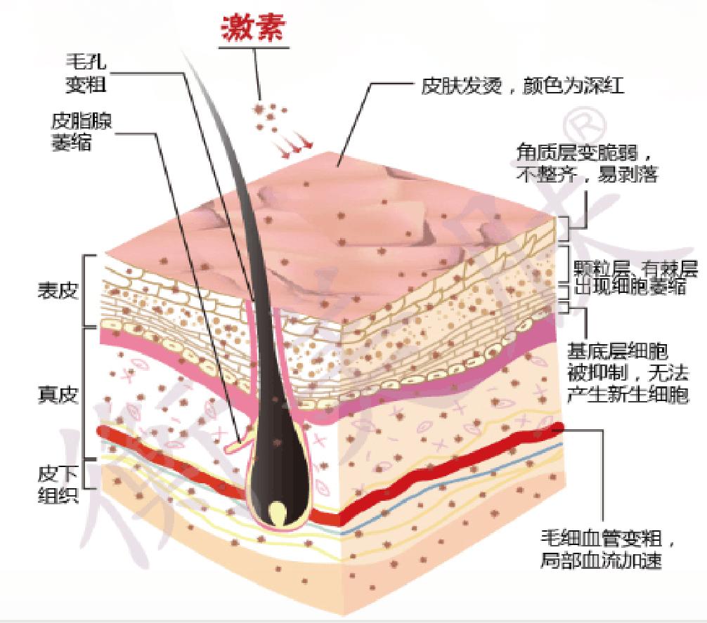 激素皮炎脸怎么修复,小儿皮炎用激素软膏