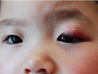 治疗麦粒肿最快的方法,左氧氟沙星治疗麦粒肿