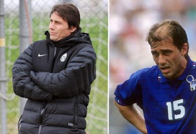 孔蒂植发效果图,孔蒂脱发