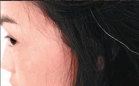 白头发中医治疗快还是食疗比较快,青年人吃什么可以预防白头发