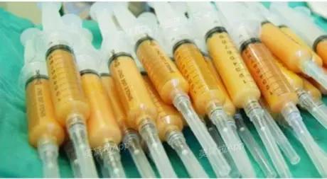 法令纹是填充好还是做筋膜提拉好,法令纹深提拉还是填充好