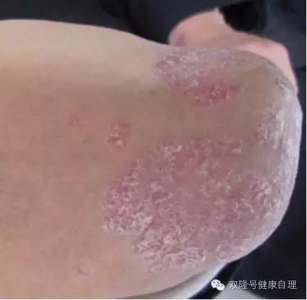 中医说吃醪糟的好处,中医说伤阴最严重症状