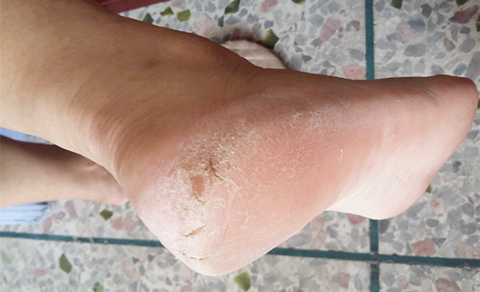 脚部干裂怎么解决图片大全,脚部干裂并且很痒怎么办